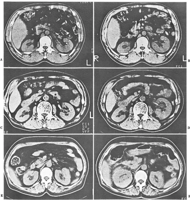 Fig.  2.  Renal  enlargement  after ESWL is  due  to  parenchymal  swelling ,  hydronephrosis  and  subcapsular  hematoma ‘ 