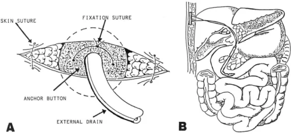 Fig.  1.  Procedure  of  biliary  en doprosthesis 