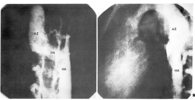 Fig.  3.  Left  postrenal  IVC  with  interruption  in  AP  (A)  and  lateral  view (B)
