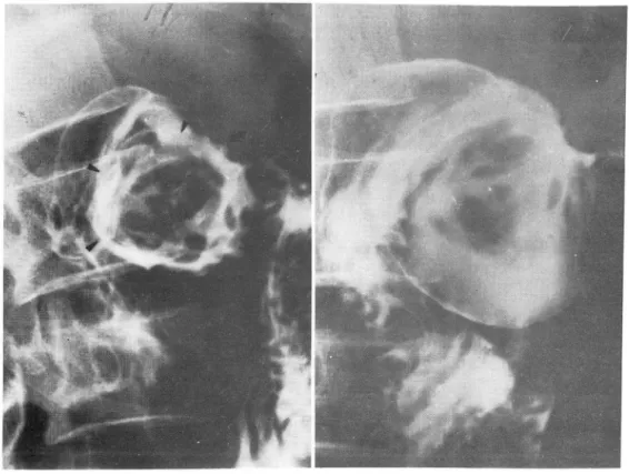 Fig.  1.  Case  J:  UGI S 