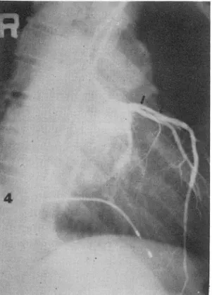 Fig.  4.  Satisfactory post-dilation appearance after PTCA  (arrows). 