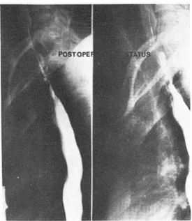 Fig.  3.  Postoperative follow up esophagogram. There is  no  evidence  of  leakage  of  contrast  media 