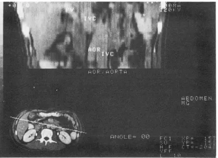 Fig.  2.  Reconstructed image of great vessels shows transposition of vena cava  in  infrarenal  portion