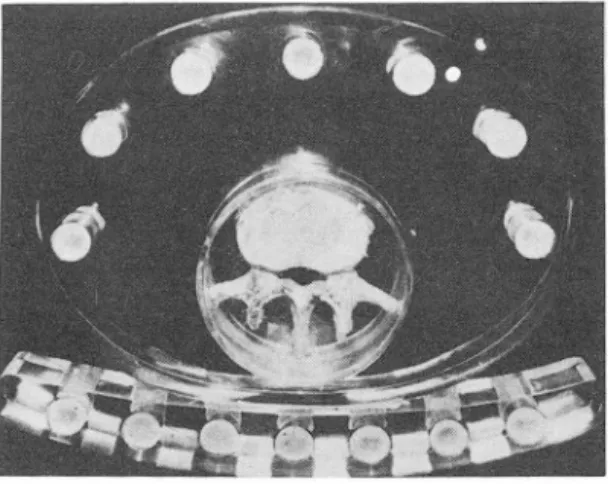 Fig.  1.  Calibration  solution  cylinders  in  human  torso  phantom  with  spi ne  spe cime n  and  scanning  phantom  전산화단층촬영 기 는  부산대학교  의 파대학  부속병원에  설치펀  Genera l  E l ec t ri c  사  제 품인  G E  CT / T  8800  을  사용하였으며 ，  절펀 두끼1  10 mm ,  촬영조건  120KVp 