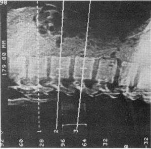 Fig.  5.  ROI  positioned  at  cancellous  portion  of  midvertebral  level  of  Ll spine 
