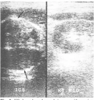 Fig.  2.  US  shows large hypoechoic mass  with  massive  peripheral and central calcifications in  posterior  to  the  right hepatic  lobe