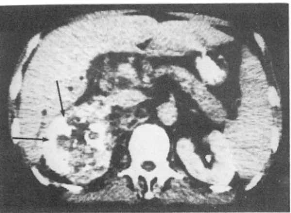Fig.  4.  Below  the  2cm  from  Fig.  3.  large  mass  with  mottled ca \c ification is seen on right adrenal area