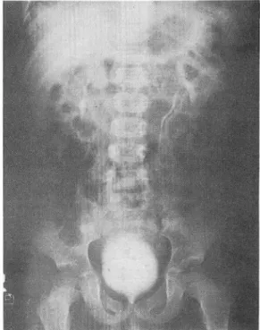 Fig.  1.  Chest  P.A  view  shows  a  large  soft tissue mass over the lateral  chest  wall  and  the  right  axilla