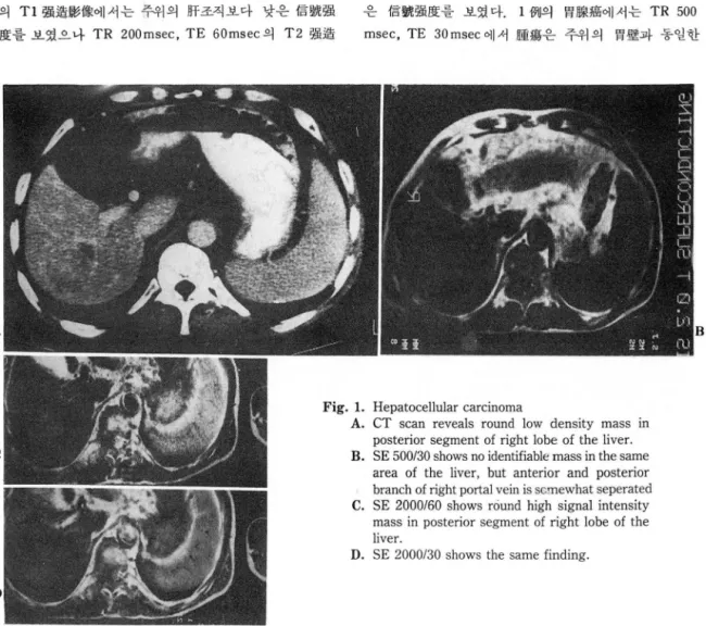 Fig.  1.  Hepatocellular  carcinoma 