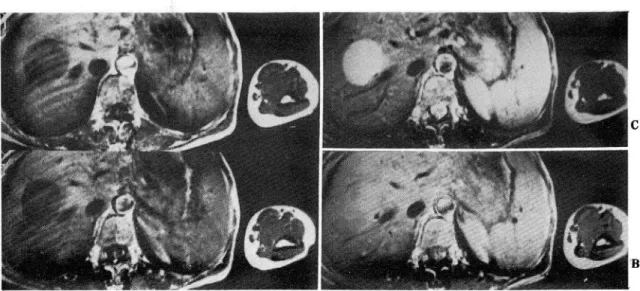 Fig.  3.  Simple  hepatic  cyst 