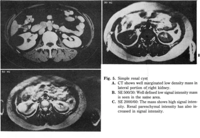 Fig.  5.  Simple  renal cyst 