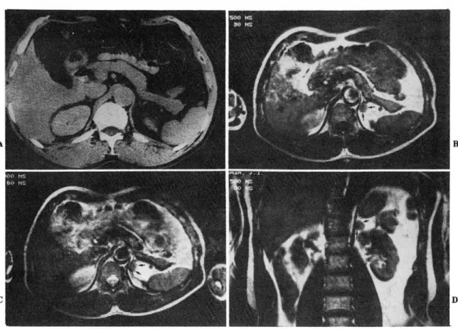 Fig.  6.  Adrenal cortical adenoma 