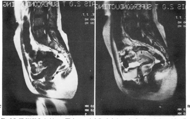 Fig.  7-C.  SE  500/30  Sagittal  image: Whole  uterus  including  body  (arrow  head)  and  cervix  (arrows)  is  well  demonstrated ,  but  cervix  mass cannot be  identified