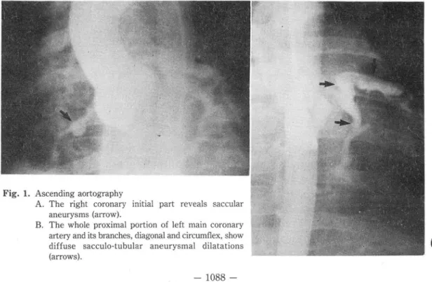 Fig.  1.  Ascending  aortography 