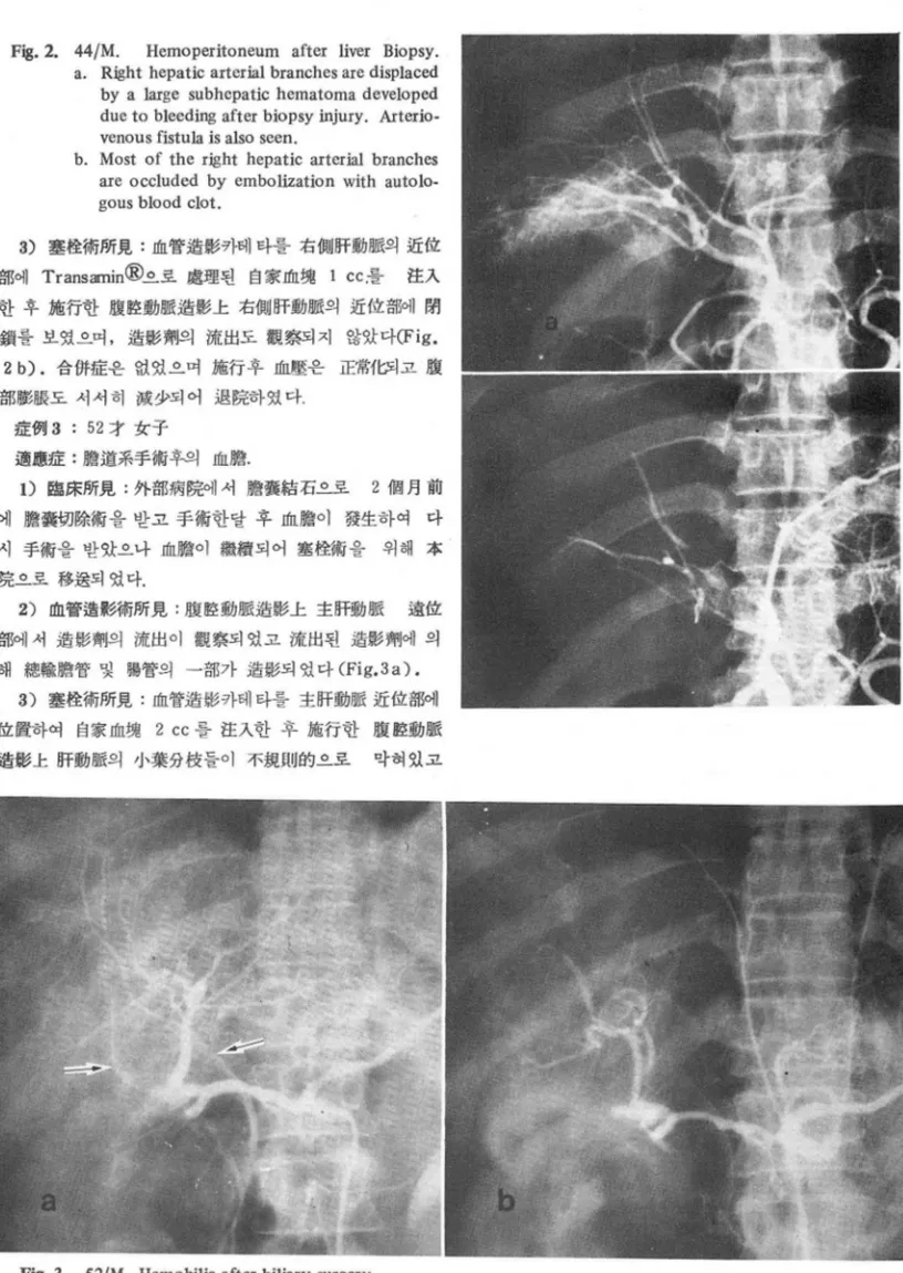 Fig. 3.  S2/M.  Hemobilia after b i1 iary  surgery. 