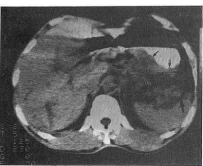Fig.  5.  Stage  IV  gastric  carcinoma:  Diffuse  thickening  in  entire gastric  wall (small arrows)