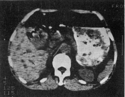 Table  10.  Resu 1t s of CT scans correlated with adhesion  into adjacent organ 