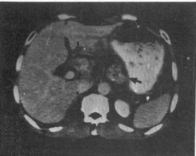 Table  1 1.  Analysis of underlying causes of incorrect  staging by CT scans 