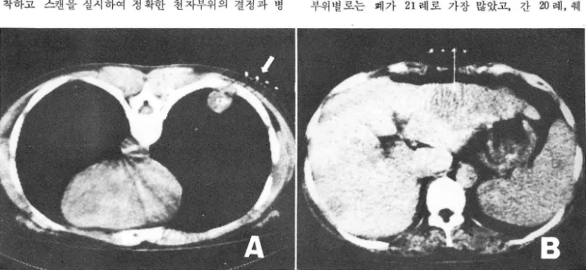 Fig.  1.  Needle  marker  (arrow)  is attached  on  the  skin  over  the  lesion  (A) ,  and  the  depth and  the  angle  fro m  skin  t。