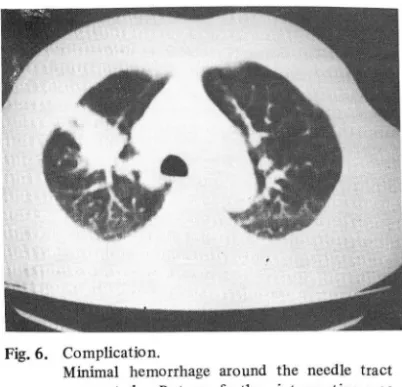 Fig.  5.  Various  types  of  fine-needle  used  in  perfcu- Fig.6.  Complication. 