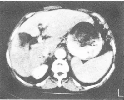 Fig.  1.  There  are  evidences  of  1i ver  cirrhosis ,  such  as  splenomegaly ,  &amp;  enlargement  of  left  lobe ,  especially  caudate  lobe