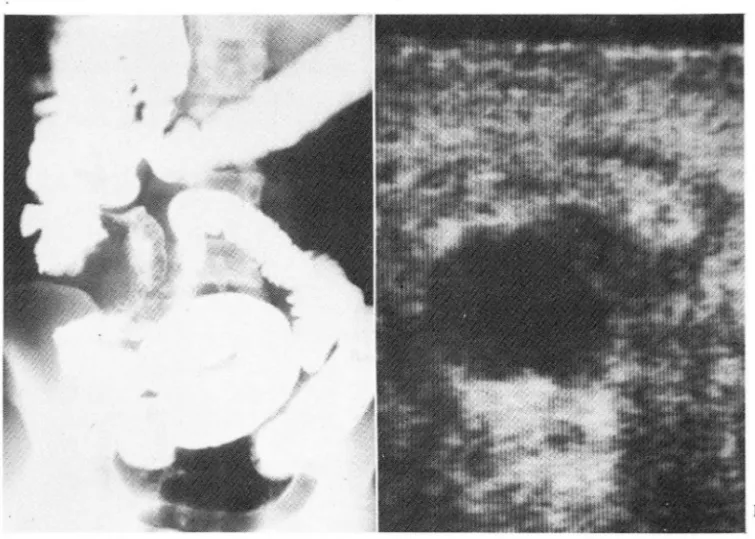 Fig.  2.  Periappendiceal  abscess.  a.  Mass  effect  on  the  cecum  and  the  terminal  lieum with  edematous  change  and  nonvisualization of the  appendix