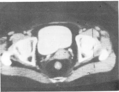 Fig. 1. 年都別分布는 全@빼 서 5 야t 群이 30 例(53%)이고， 再發한 例에서는 50 代群이 14 例 (57%) 로써 가장 많은 頻度를 보였다 (Table]  )