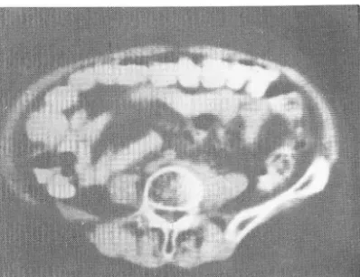 Fig.  12.  CT  scan  at  level  of  kidneys  shows  bilateral  hydronephrosis  and  extensive  retroperitoneal  lymph node metastasis