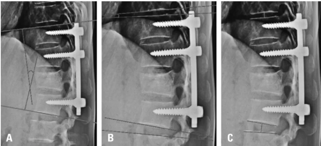 Fig. 1. Radiologic measurements of the adjacent segments. (A) Measurement of the segmental sagittal angle