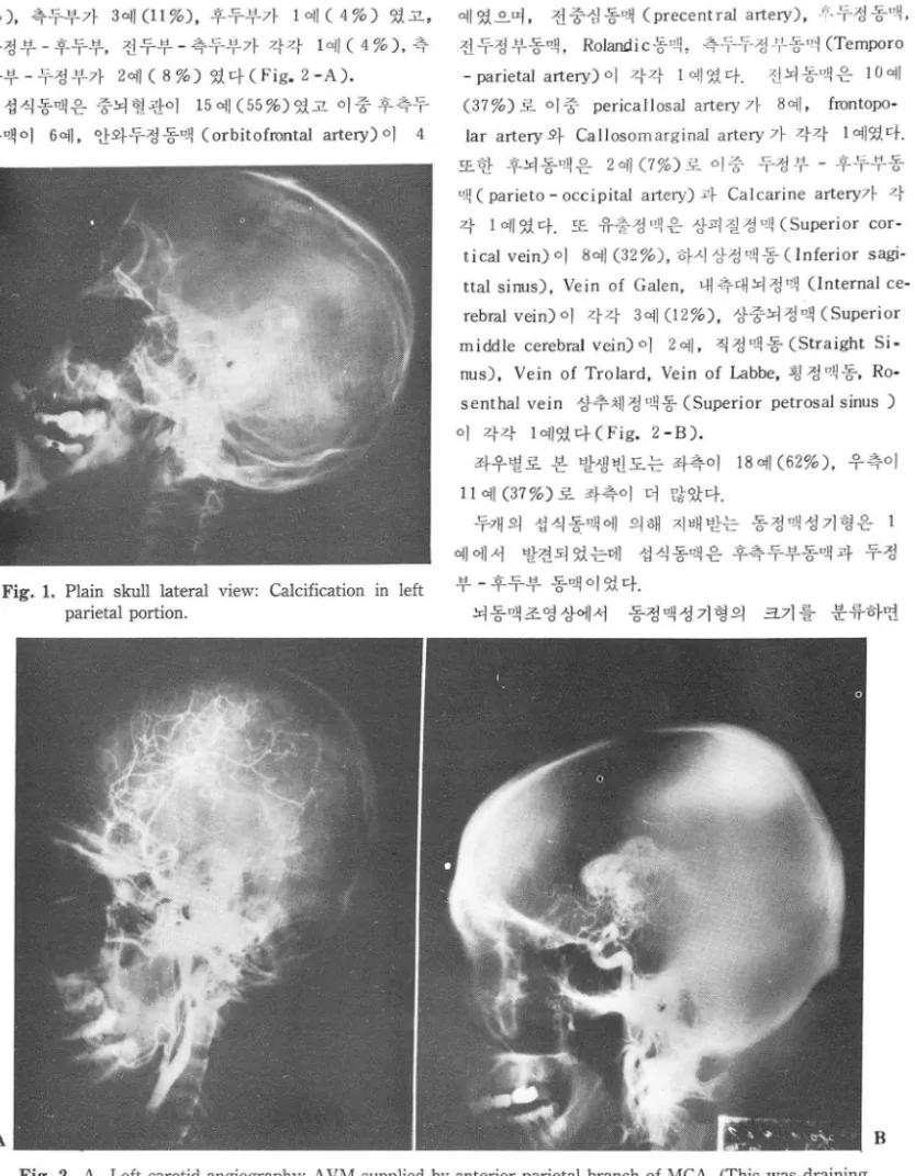 Fig.  2.  A.  Left carotid  angiography:  A  VM  supplied  by  anterior  parietal  branch  of  MCA