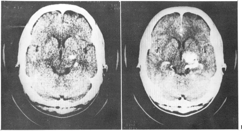 Fig. 4.0n NCCT shows high density in left front- front-oparietal area with midline shifting of the  lateral ventricle