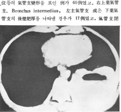 Fig.  2.  A large cavitary  mass  with  air-fluid  level  in  left  lower  lobe. 