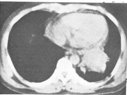 Table  5.  Relation between Enlarged Mediastinal Lyrnph  Node  and  Side  of Prirnary  Lesion  (n  =  50) 