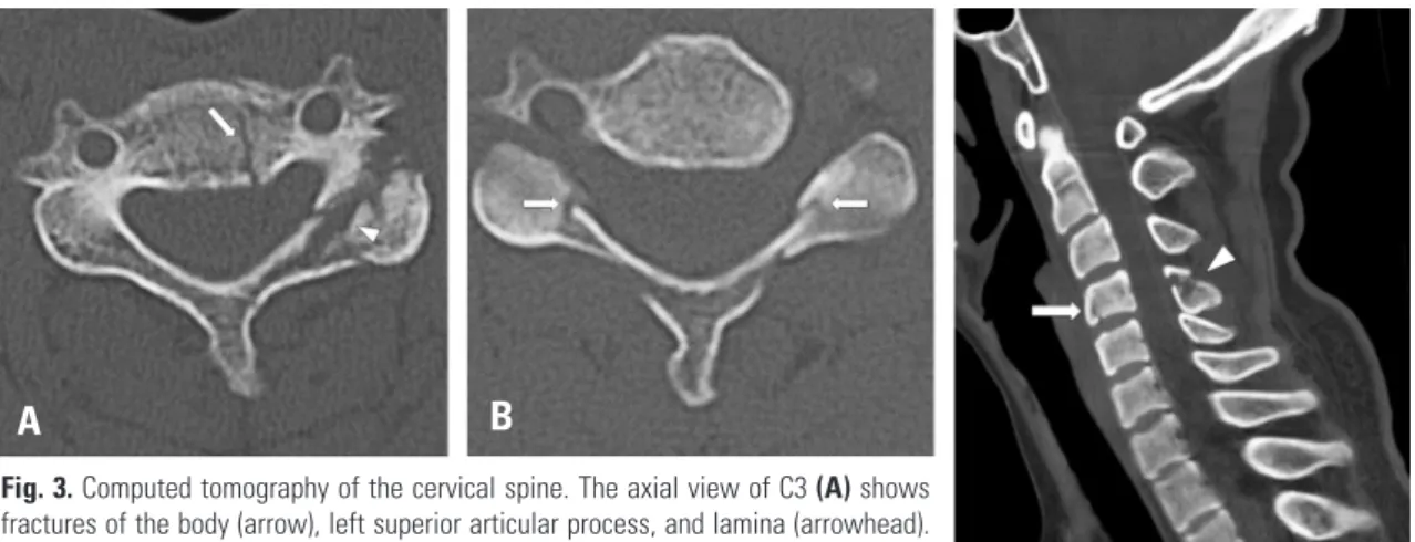 Fig. 3. Computed tomography of the cervical spine. The axial view of C3 (A) shows  fractures of the body (arrow), left superior articular process, and lamina (arrowhead)