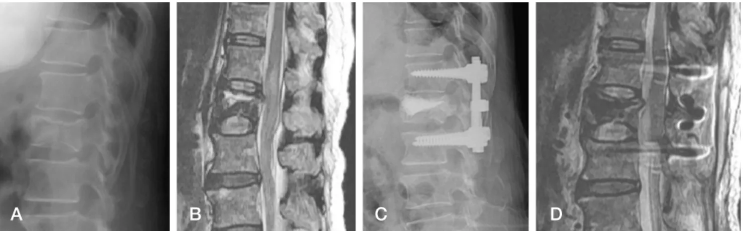 Fig. 2. Preoperative and postoperative simple radiography (A, C) and MRI (B, D) of a 68-year-old female patient who had dynamic spinal cord compres- compres-sion due to an intravertebral instability showing a spinal cord signal change on the MRI without a 