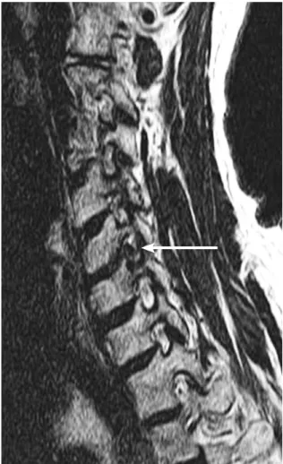 Fig. 1. Pre-existing foraminal stenosis of cervical spine at the  oblique view of MRI.