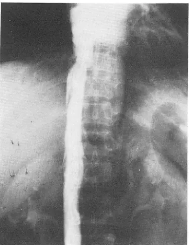 Fig.  4.  Immediate follow-up  cavography after PTA show- show-ed good  patency of the  hepatic  segment of  IV C