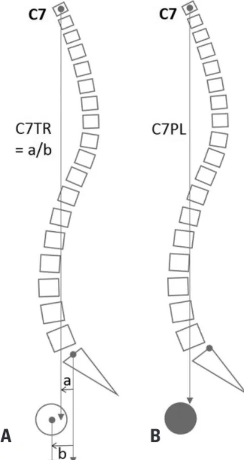 Fig. 1. The C7 translation ratio (A) and the horizontal position of C7PL (B)  between the hip joint and the posterior end of the sacral endplate.