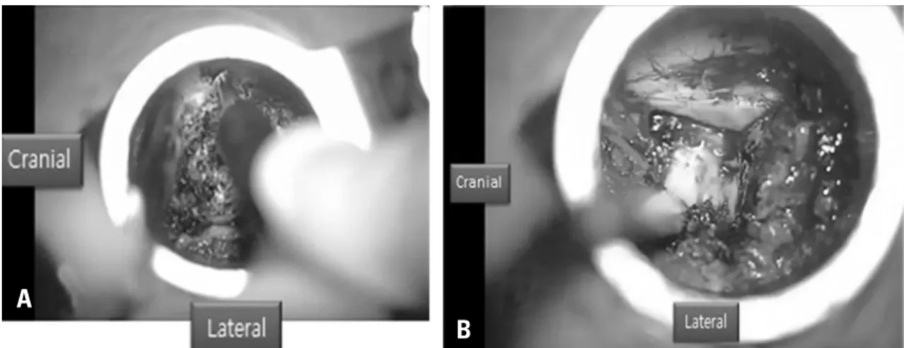Fig. 3. If a more central and/or contralateral decompression was desired (as for concomitant spinal stenosis), the tubular retractor was wanded medially  (A)