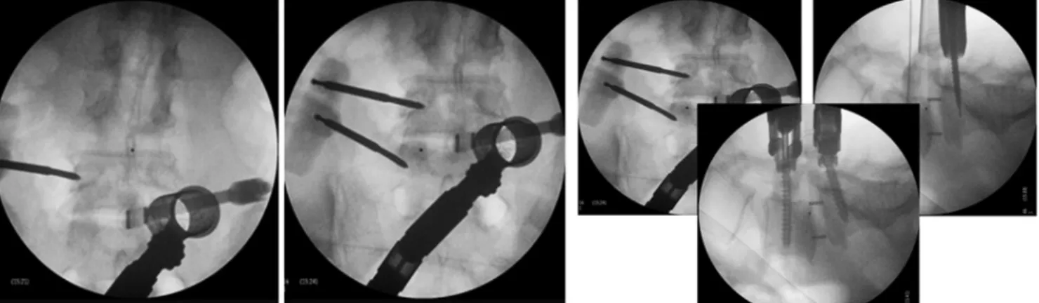 Fig. 4. Contralateral placement of percutaneous pedicle screws and interbody traction to restore optimal disc height.