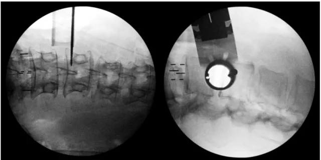 Fig. 3. Intraoperative fluoroscopic anteroposterior and lateral images show the optimal placement of the tubular retractor for the  operation