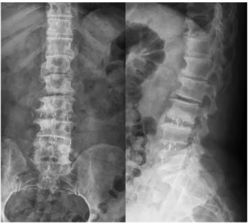 Fig. 4. A schematic figure shows the difference between the direct lat- lat-eral interbody fusion and oblique latlat-eral interbody fusion approaches for  the lumbar spine (see arrows)