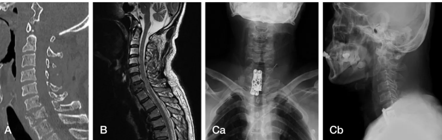 Fig. 1. case 1; 53-year-old man with C7 fracture(Vertical compression injury) who become incomplete quadriplegia (Brown-Sequard syndrome) follow- follow-ing fall down accident