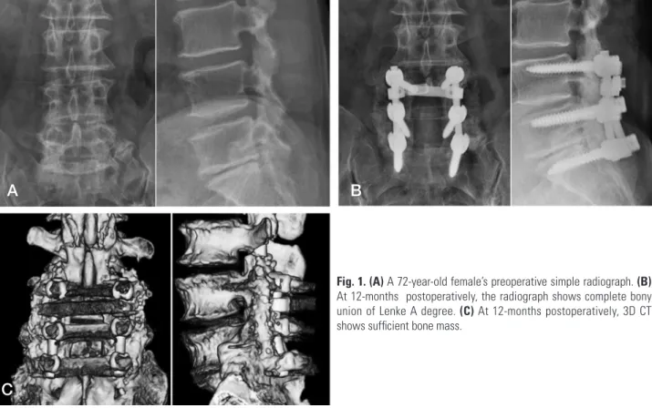Fig. 1. (A) A 72-year-old female’s preoperative simple radiograph. (B)  At 12-months  postoperatively, the radiograph shows complete bony  union of Lenke A degree