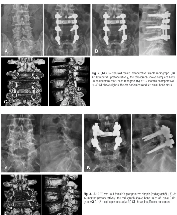 Fig. 2. (A) A 57-year-old male’s preoperative simple radiograph. (B)  At 12-months  postoperatively, the radiograph shows complete bony  union unilaterally of Lenke B degree
