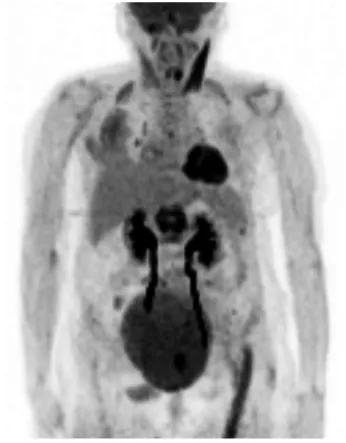 Fig. 1. Anteroposterior and lateral X-rays of the T-L spine show a T12  compression fracture.
