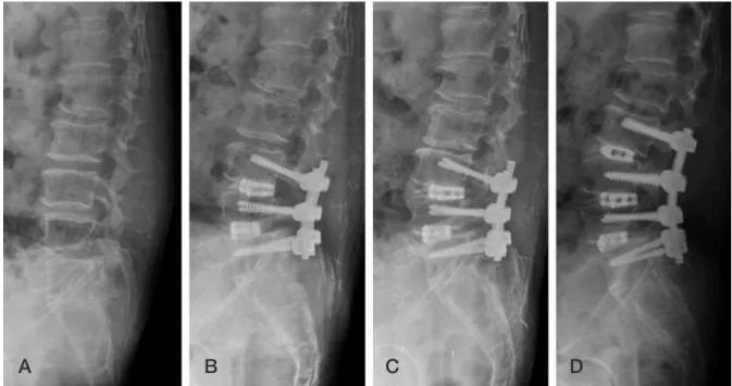 Fig. 1. (A) Initial diagnosis was degenerative spondylolisthesis L3-4-5. (B) PLIF was done L3-4-5