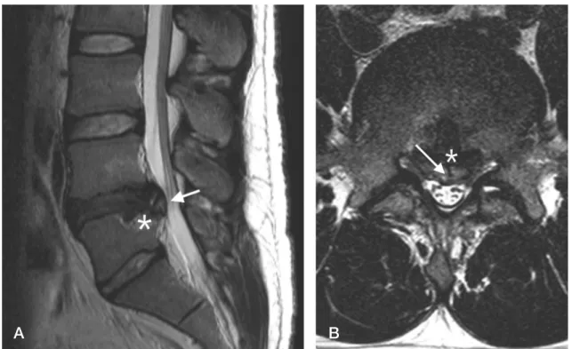 Fig. 1. (A-B) A sagittal and axial T2 weighted MRI of L4-5 level shows herniated disc material and bony fragment (white arrow)  located centrally and markedly occupying the spinal canal space