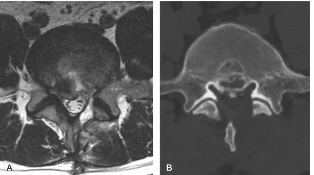 Fig. 3. (A-B) Postoperative  MRI and  CT show a decompressed left lateral recess.