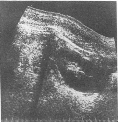 Fig.  2.  A well  circumscribed  and  huge  mass with  cystic  Fig.  4.  Longitudinal section of ultrasound ,  a well demar- demar-changes  from  central  necrosis